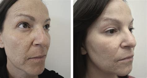 Laser Wrinkle Removal Dermatologists In Crest Hill And Naperville