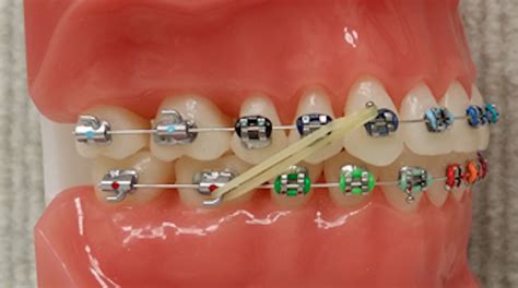 Elastics Gorton And Schmohl Orthodontics Braces Colors Gorton