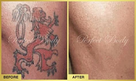 We are the only personal cosmetic facility that offers such a wide variety of laser treatments, including laser hair removal, cellulite reduction, body reshaping, skin tightening, skin resurfacing, laser tattoo. Tattoo Removal Gallery - Perfect Body Laser & Aesthetics ...