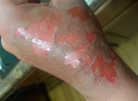 Sometimes, the degree of burn you have will change. Second Degree Burn Pictures Treatment & Symptoms | TCG ...