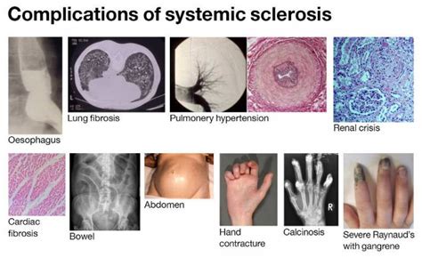 Scleroderma Institute Of Immunity And Transplantation Ucl