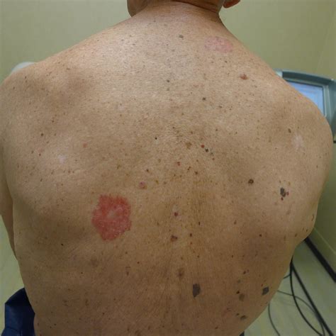 Early Signs Of Skin Cancer On Back