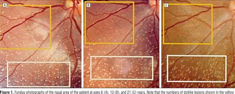 Figure 1 From Long Term Fundus Changes Due To Fundus Albipunctatus