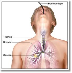 Bad breath may indicate oral cancer, although it's also a symptom of a sinus infection. What is Lung Cancer? Survival Rate, Causes, Stages and ...