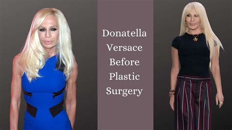 Donatella Versace Before Plastic Surgery Disaster Story The Healthstore