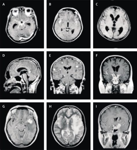 Serial Mri To Determine The Effect Of Dexamethasone On The Cerebral