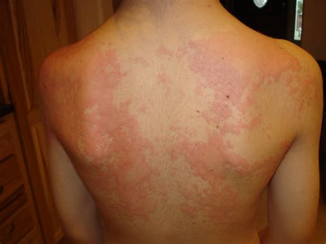Pics Photos Hives From An Allergic Reaction
