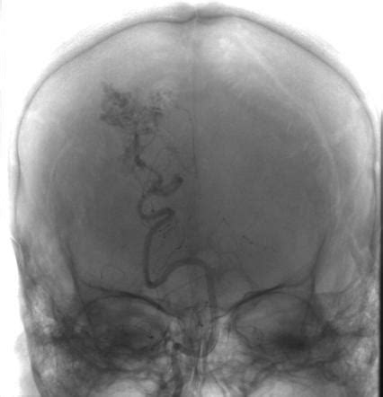 Cerebrovascular Malformations Radiology Reference Article