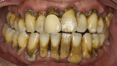 14 Disgusting Pairs Of Teeth Gallery Ebaums World