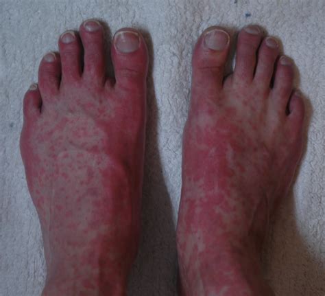 Collection 96 Pictures Red Rash On Lower Legs Above Ankles Photos Full