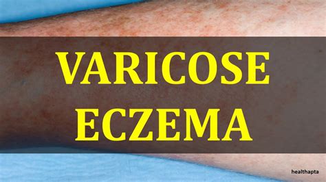 Varicose Eczema Youtube