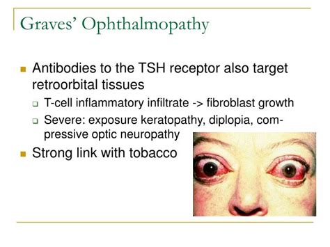 Ppt Graves Disease An Overview Powerpoint Presentation Id3401926