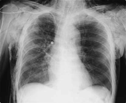 Chest X Ray Revealing Subcutaneous Emphysema And Pneumothorax My Xxx