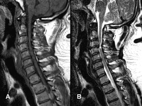 Cervical Spinal Stenosis Mri