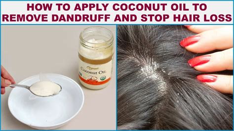 How To Use Coconut Oil For Dandruff 3 Effective Ways To Fight Dandruff Aimdelicious