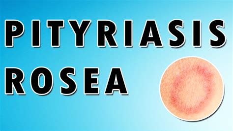 pityriasis rosea treatment causes and signs herald patch and rash [dermatology course 49 60