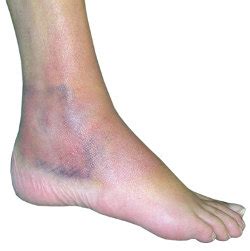 Wenn die schmerzen dann später doch wiederkommen, behandlungen wieder kurz halten. schmerzen im knie innenseite