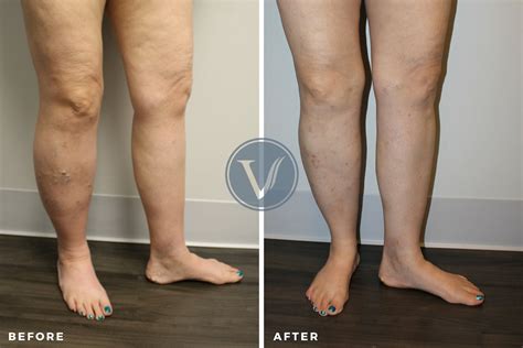 Restless Leg Syndrome Treatment The Vein Institute At Ssa