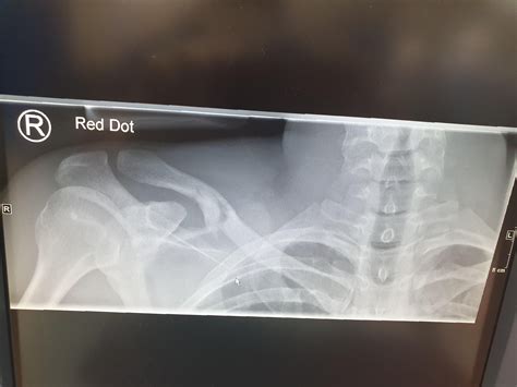 Well Thats Me Out The Club Broken Collarbone Fractured Spine And