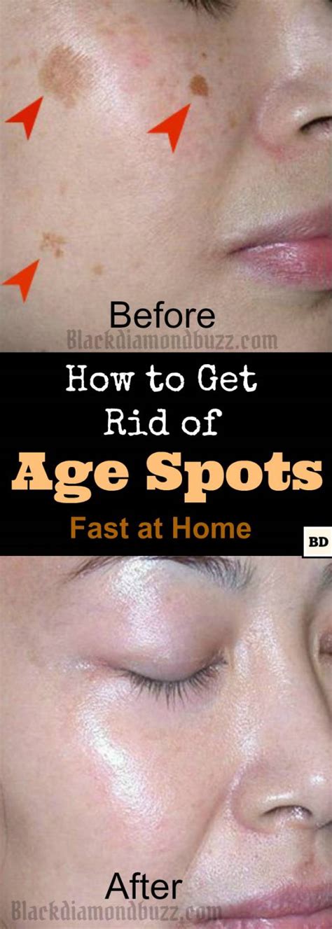 But they can spread to other areas if you don't get rid of them as soon as you identify them. How to Get Rid of Age Spots on Face | 7 Home Remedies That ...