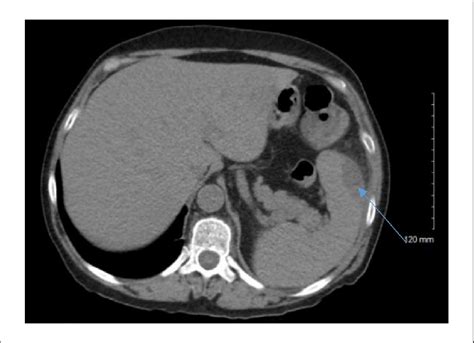 Computed Tomography Of Abdomen With Contrast Demonstrating Splenic