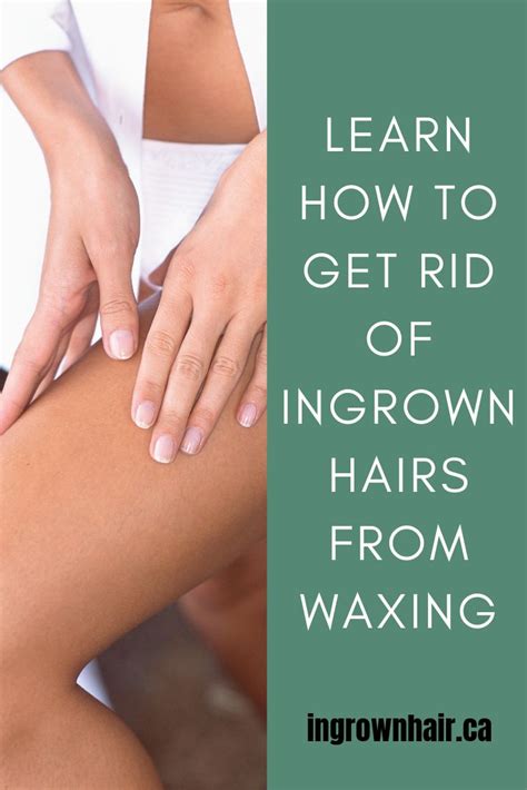 How To Get Rid Of Ingrown Hairs From Waxing Ingrown Hair Solutions Ingrown Hair From Waxing