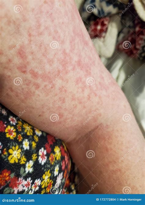 Dermatitis On A Womans Arm Rash Blotches Stock Photo Image Of