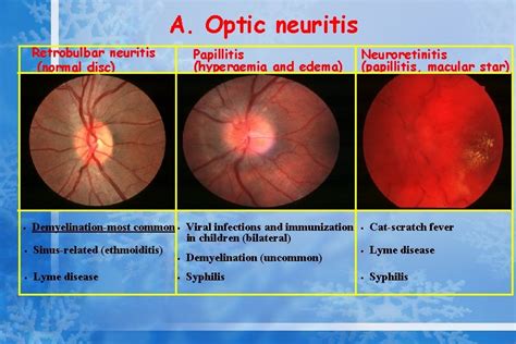 Optic Nerve Diseases Visual Field Dr Canan Asl