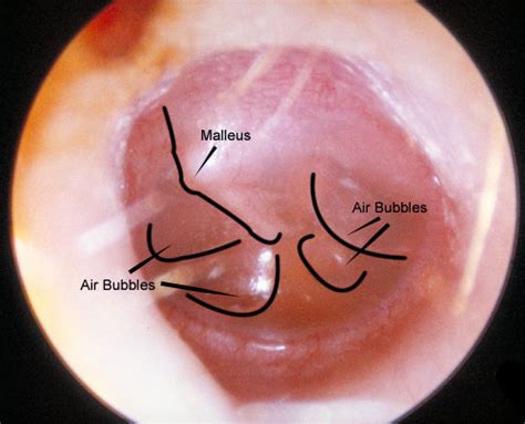 Fluid In The Ear Images Mcgovern Medical School