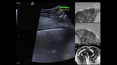 White Paper Lung Ultrasound In Patients With Coronavirus Covid 19 Disease