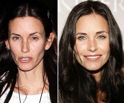 Pin on Celebrities and Plastic Surgery