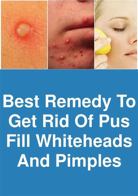 Pin On Whiteheads Removal