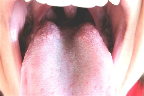 Help Please Im Scare This Can Be Hpv Oral And Dental Problems
