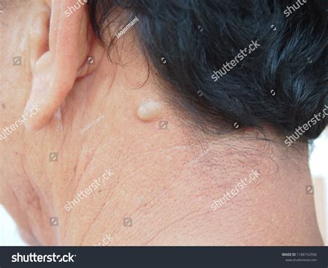 Sebaceous Cyst On Neck Man Form Foto Stock Editar Agora 1188152956