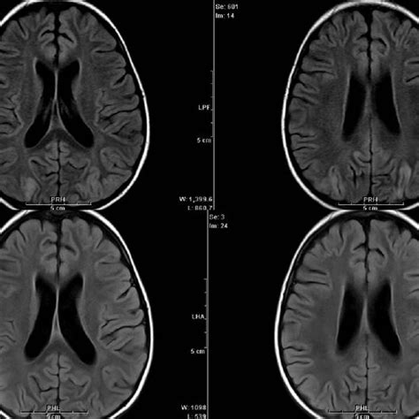 Initial Magnetic Resonance Imaging Mri Scans A And Follow Up Mri