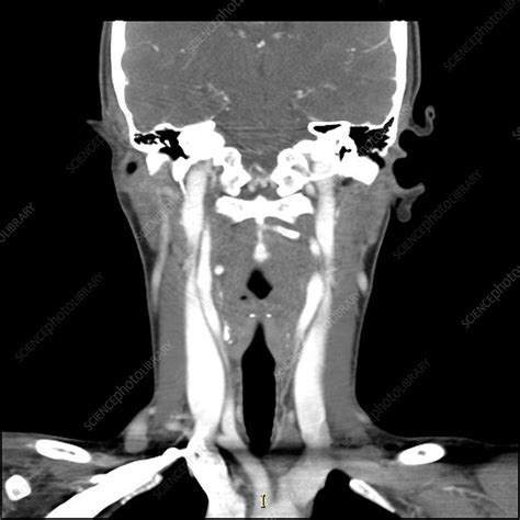 Lingual Thyroid Ct Scan Stock Image C0271862 Science Photo Library