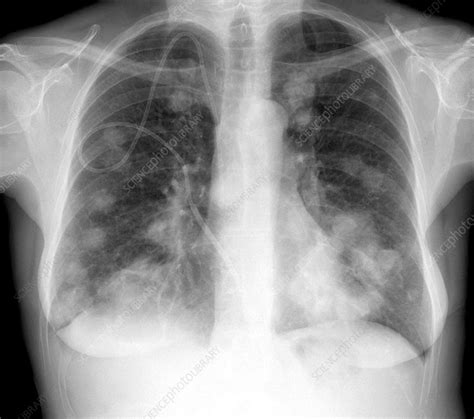 Lung Cancer X Ray Stock Image C0103592 Science Photo Library