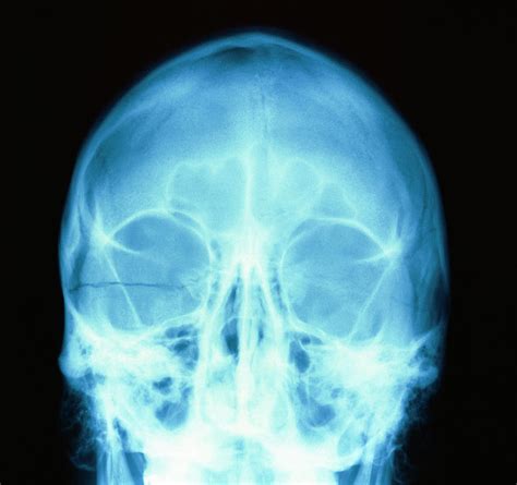 X Ray Image Of A Fractured Skull Photograph By Science Photo Library