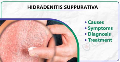 Hidradenitis Suppurativa Causes Symptoms Diagnosis And Treatment
