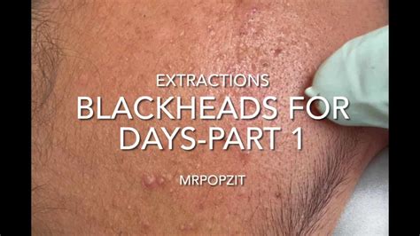 Blackheads For Days Part 1 12 Minutes Of Just The Popacne Extractions