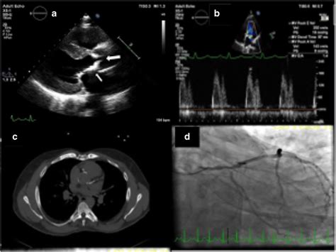 Multimodality Imaging In Racd Demonstrating Severe Aortic Valve Download Scientific Diagram