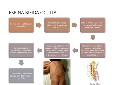 Espina Bifida