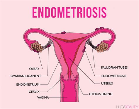 Theories on the pathogenesis of endometriosis. THE CURE OF OVARIAN CYSTS AND HOW TO AVOID IT