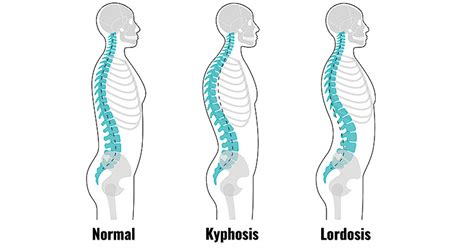 Hyperlordosis Signs Causes And Corrective Exercises