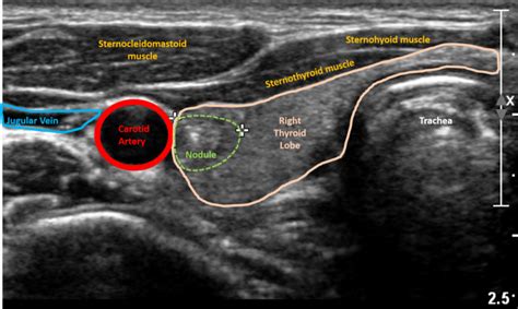 Thyroid Ultrasound Purpose And Procedure Healthtian
