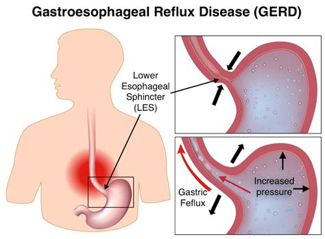 Common causes of acid reflux. 10 Causes of Chest Pain That Are Not Your Heart | Things ...