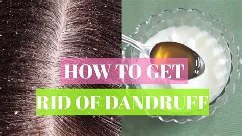 How To Get Rid Of Dandruff Home Remedies To Treat Dandruff Youtube