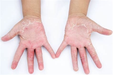 Dermatitis En Las Manos Qué Es Síntomas Y Tratamiento — Crecesalud