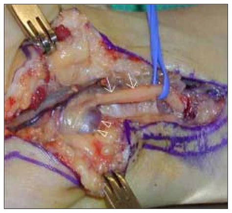 Musculoskeletal Images Ganglion Cyst Of Guyons Canal Causing Ulnar