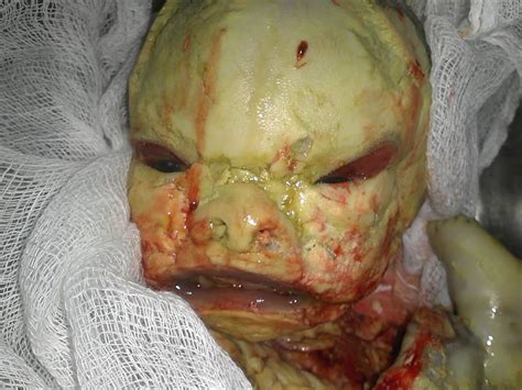 Infants with this condition are born with very hard, thick skin covering most of their the skin normally forms a protective barrier between the body and its surrounding environment. Medical Wonders